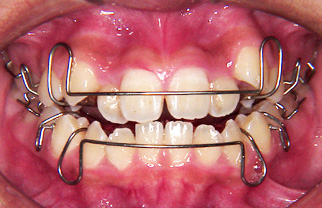 歯を抜かない歯科矯正（床矯正）に治療例